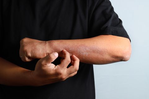 eczema allergy skin atopic dermatitis