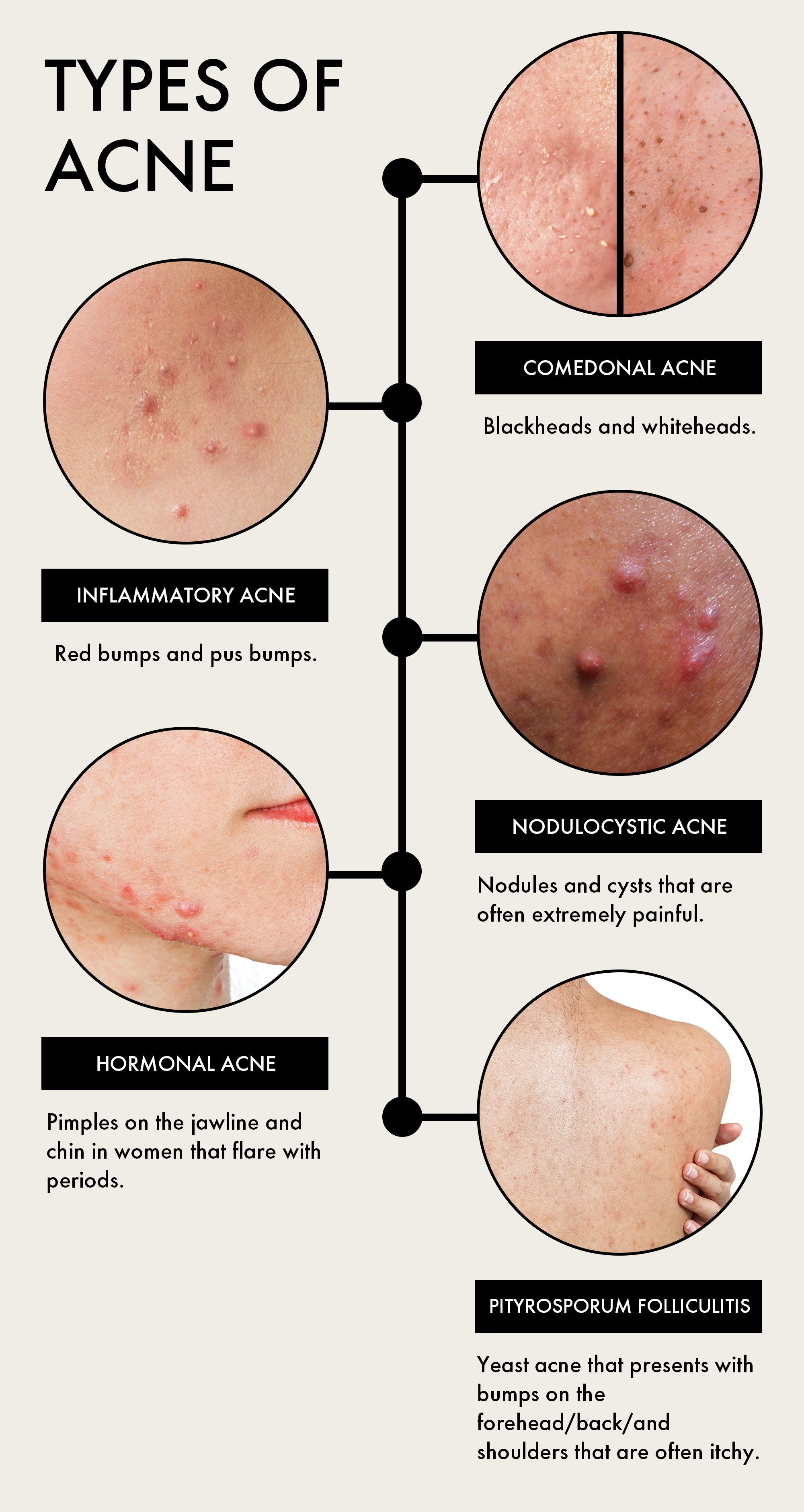 Acne Nodules On Face