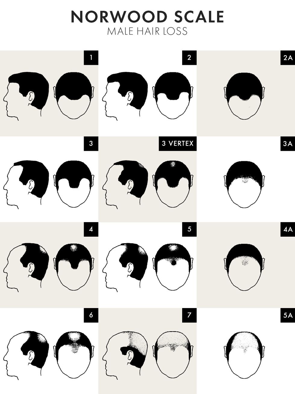 norwood scale of male hair loss
