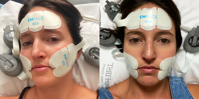 Emface review: the 20 minute needle-free facelift that sculpted my jawline, Beauty