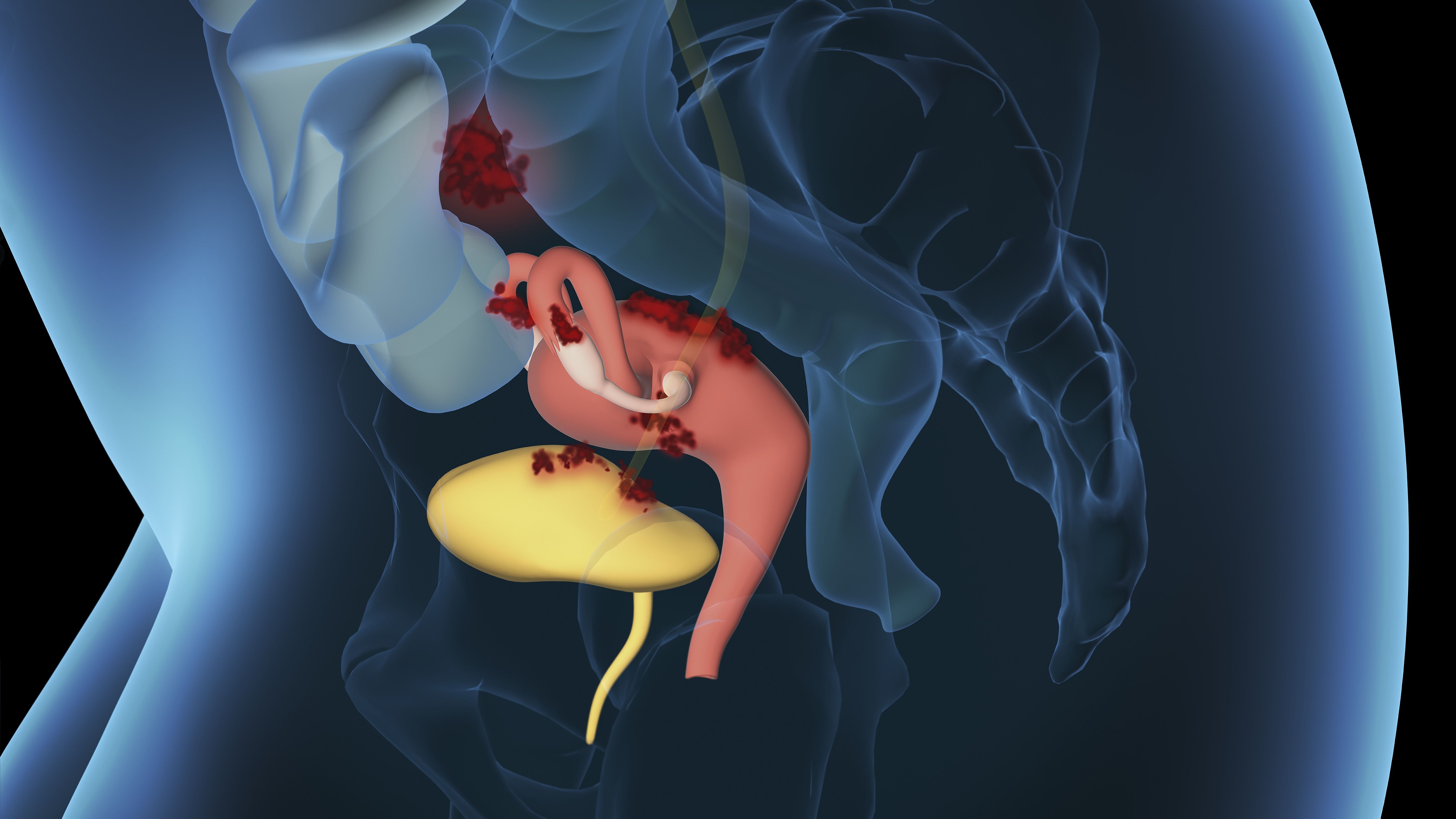 endometriosis, 3d illustration