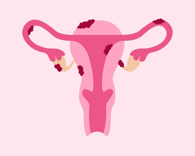 endometriosis disease uterus with tissue growth