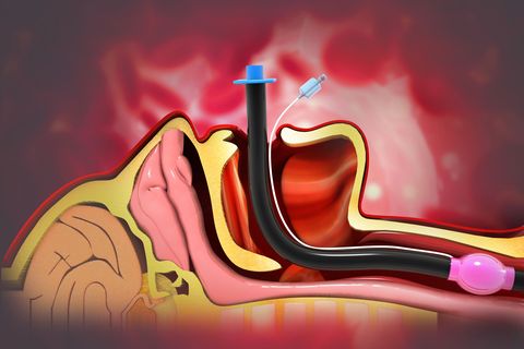 endotracheal intubation on scientific background