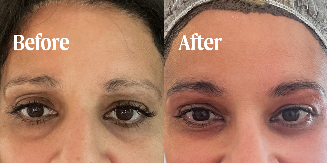 minoxidil before and after eyebrows