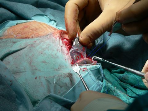 Een chirurg plaatst een cochleair implantaat achter het oor van een patint met gehoorverlies De binnenkant van het implantaat ontvangt signalen van de buitenkant die normaal gesproken achter het oor zit