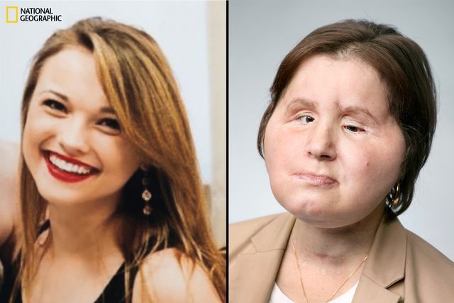 At 21, Katie Stubblefield became the youngest person in the United States to have a face transplant.
