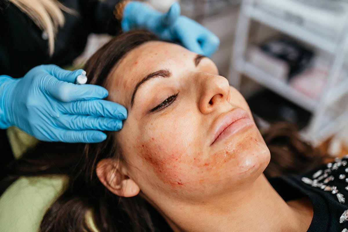 Prp Facial Treatments: What Is A ‘vampire Facial’?