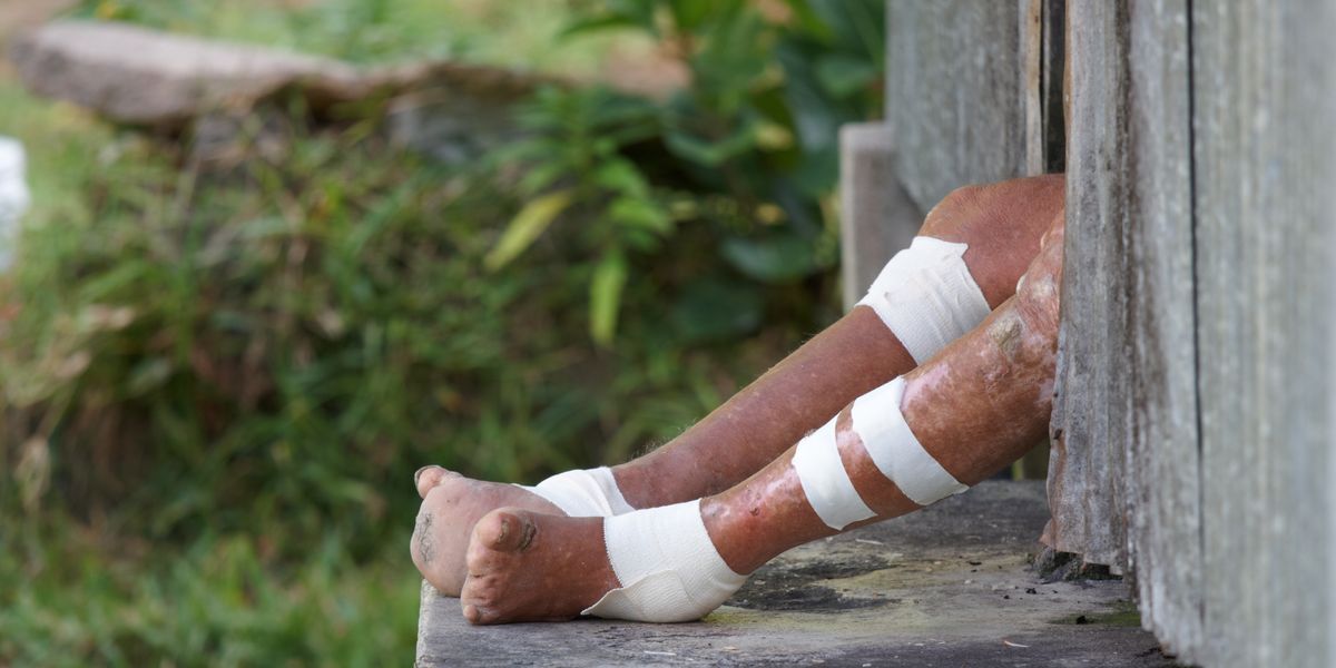Leprosy in Florida What's Behind the Increase in Cases?