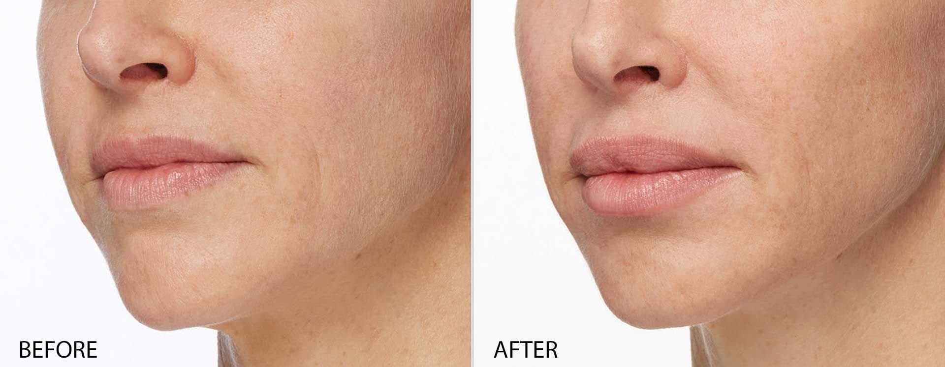 Lip Filler Myths Busted: Using Straws - Skin Deep Med Spa