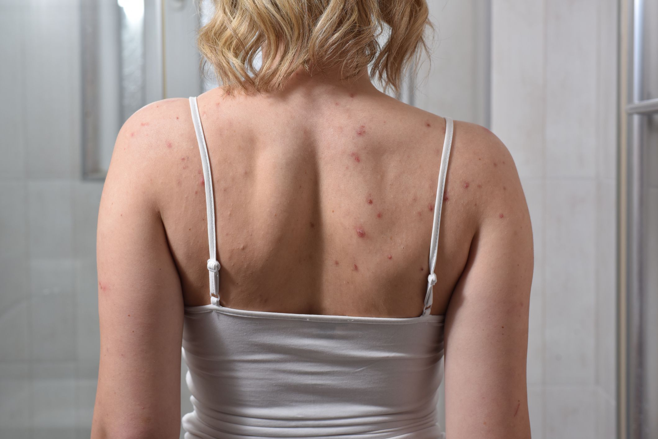 How to Get Rid of Back Acne, According to Dermatologists