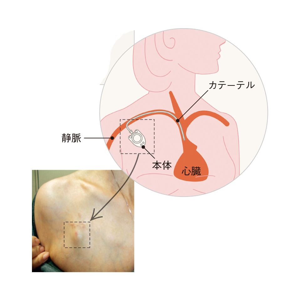 医療の現場で活躍する、血管に負担をかけない点滴用「ポート」とは