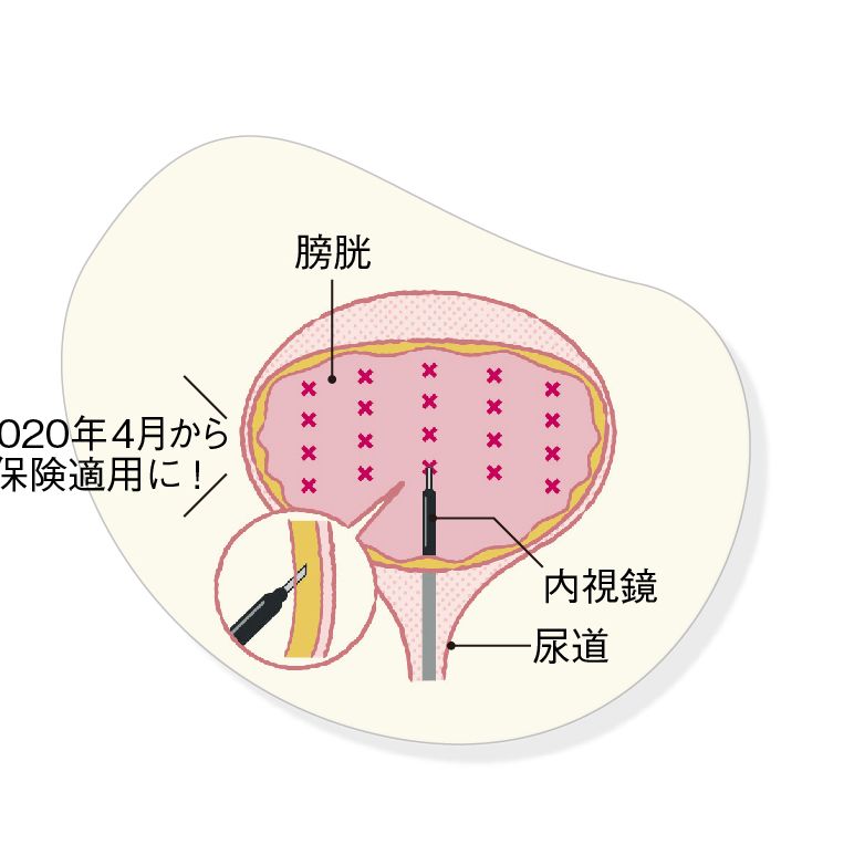 尿漏れ、頻尿の治療　ボツリヌス毒素膀胱壁内注入療法