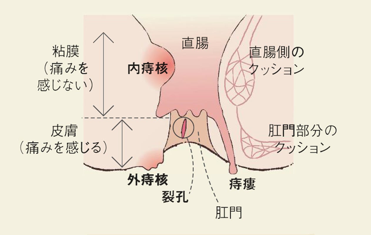 トイレの血便