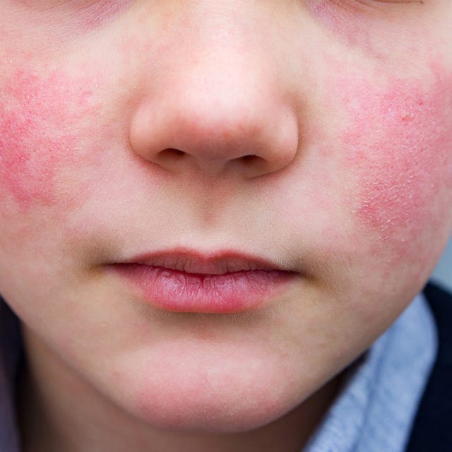 a common symptom of fifth disease is rash ﻿