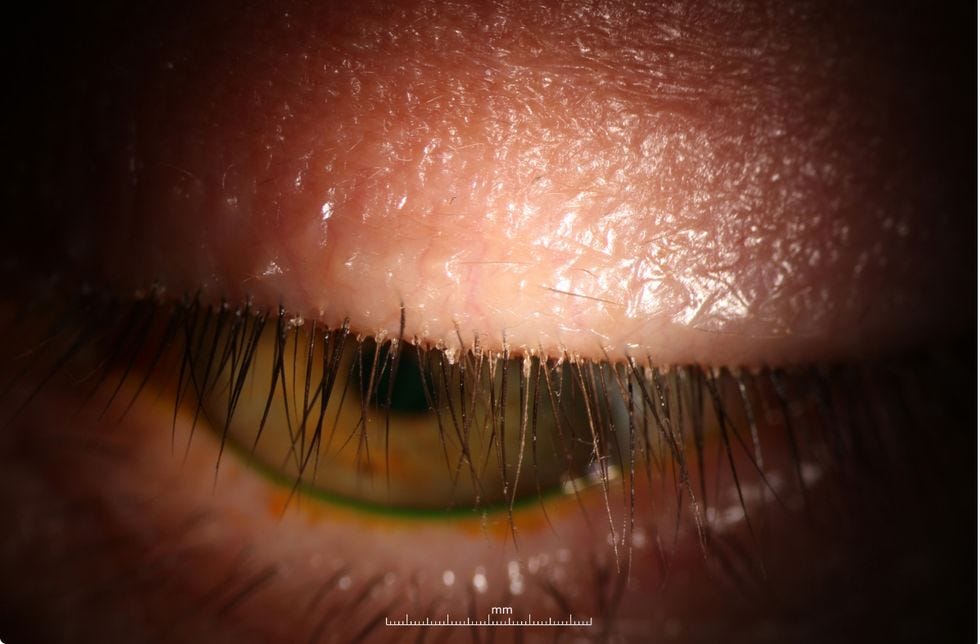 demodex blepharitis