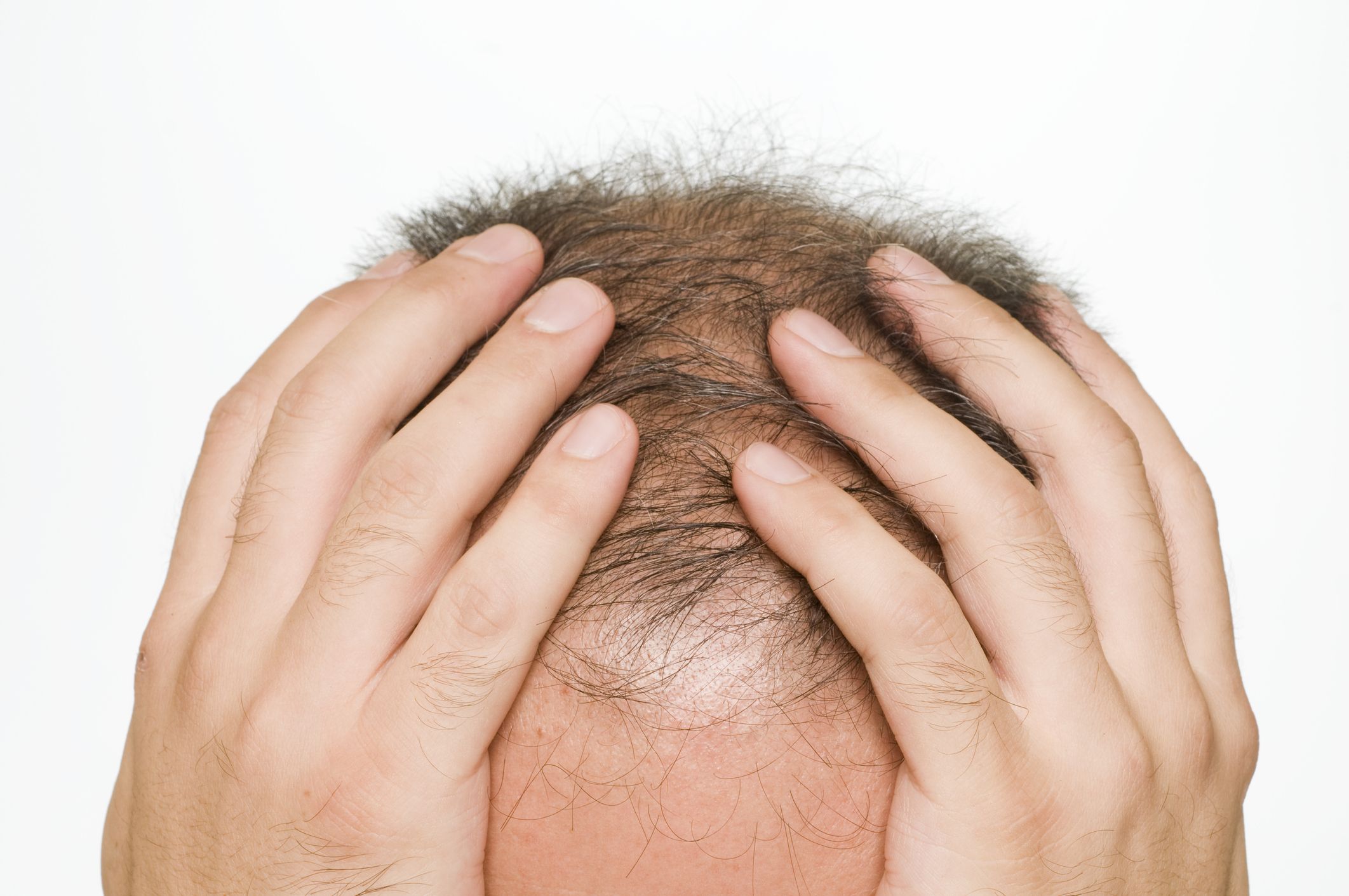 venden finasteride sin receta