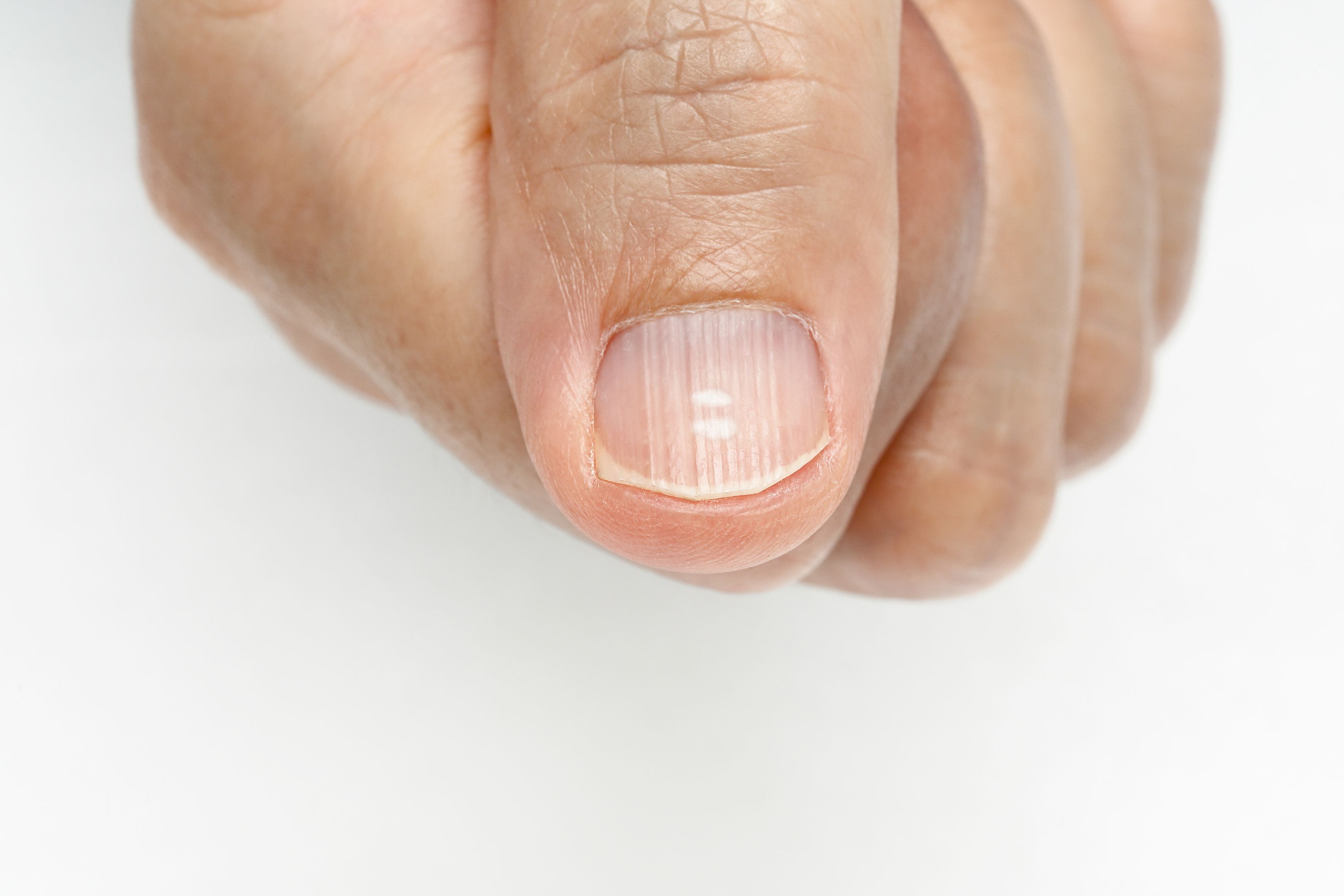 What Causes Dry & Cracked Skin Around the Fingernails? | Healthfully