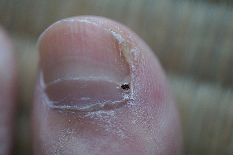 horizontal fingernail ridges