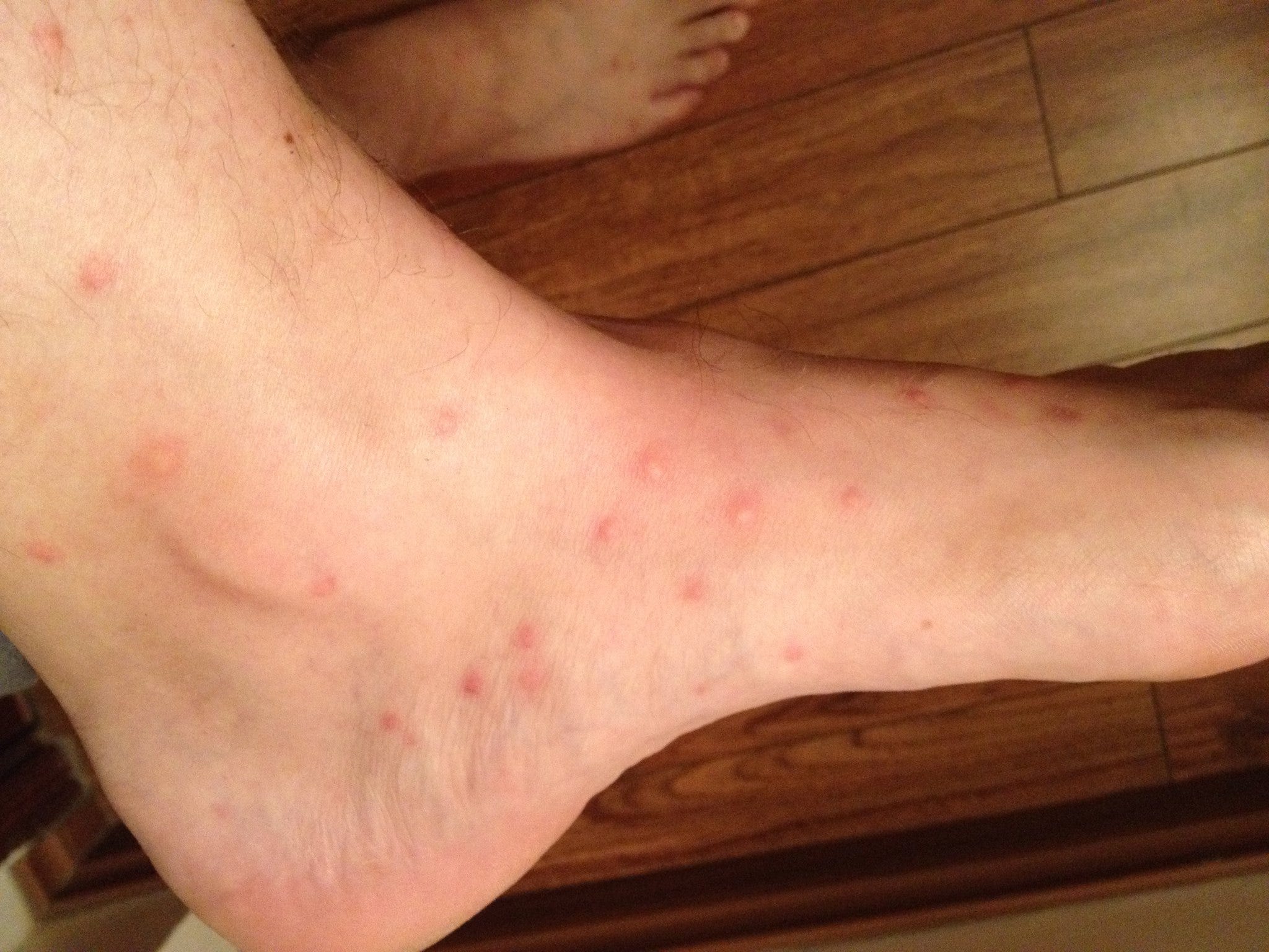 How To Tell If That Itch Is A Bed Bug Or Sand Fly Bite - q6qhpkw