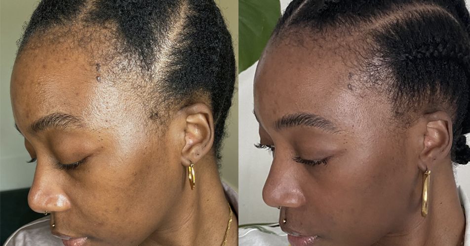 What Are The Signs Of New Hair Growth? All You Need To Know