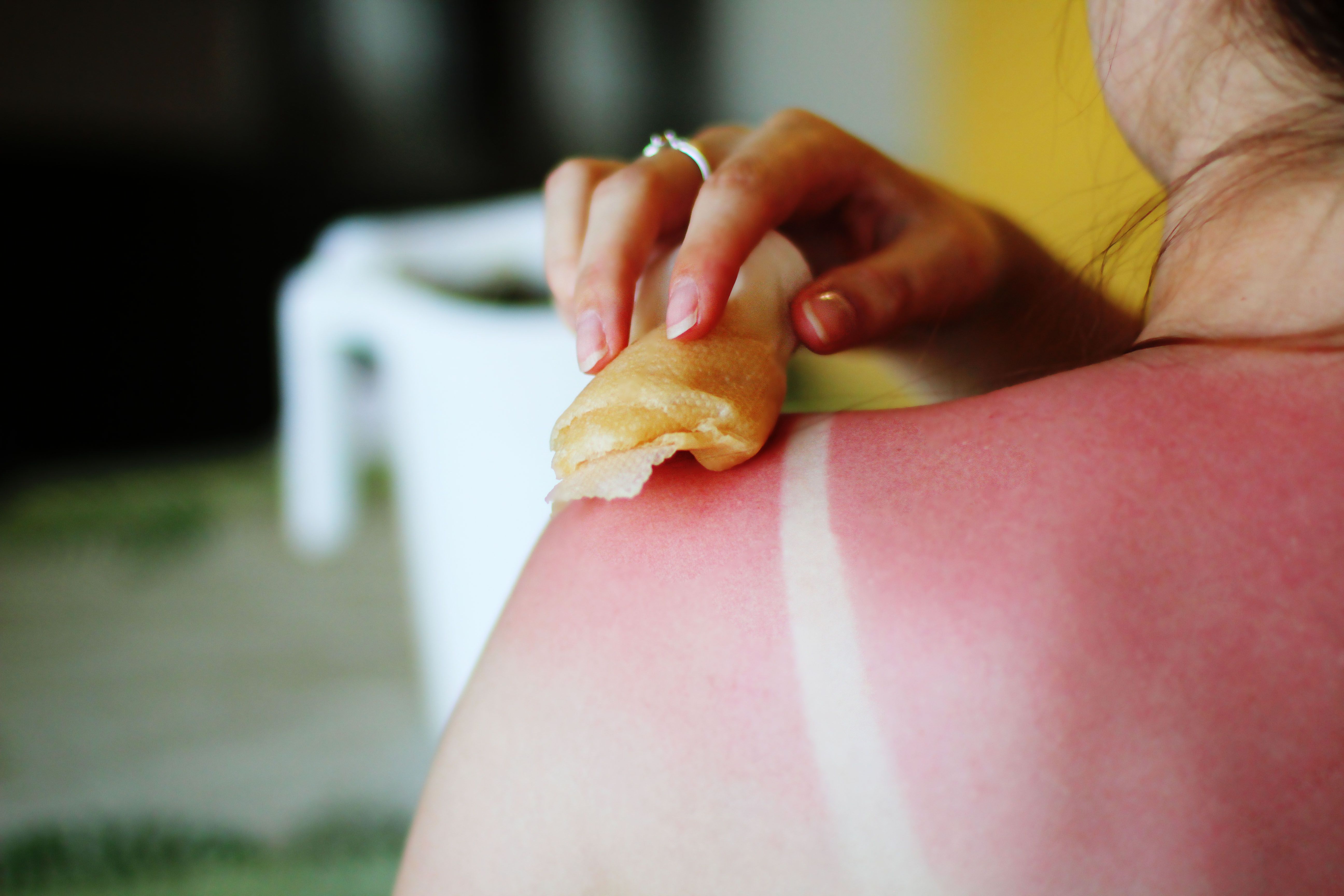 Folk remedies for sunburn