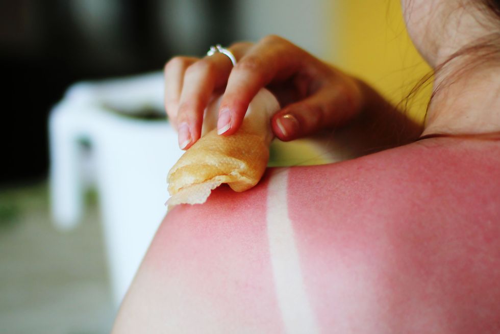Folk remedies for sunburn