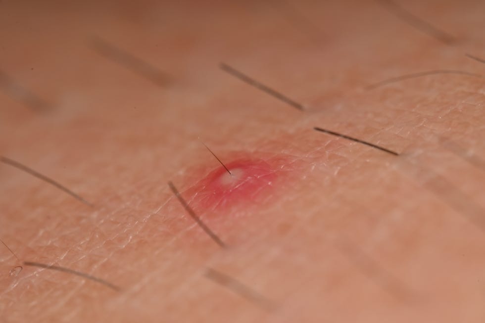 a folliculitis on hair follicle