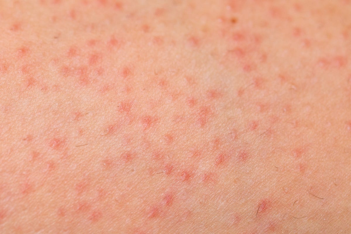 How to Get Rid of Fungal Acne - What Does Fungal Acne Look Like?