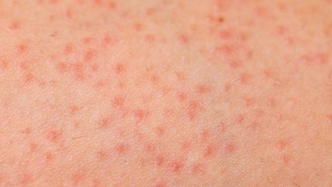 preview for Must-Know Facts About Adult Acne