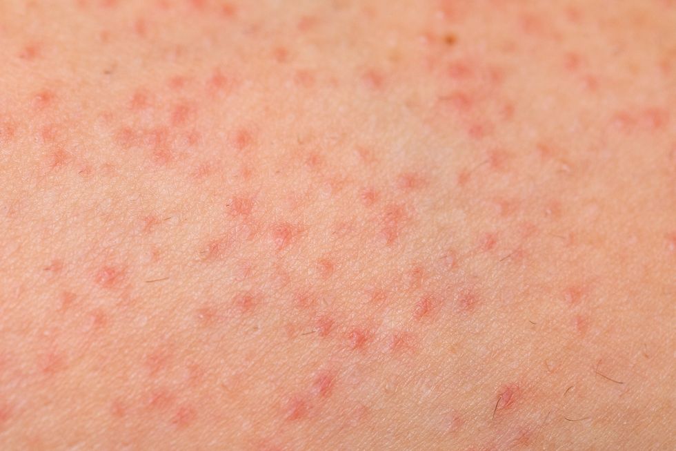 folliculitis on female skin