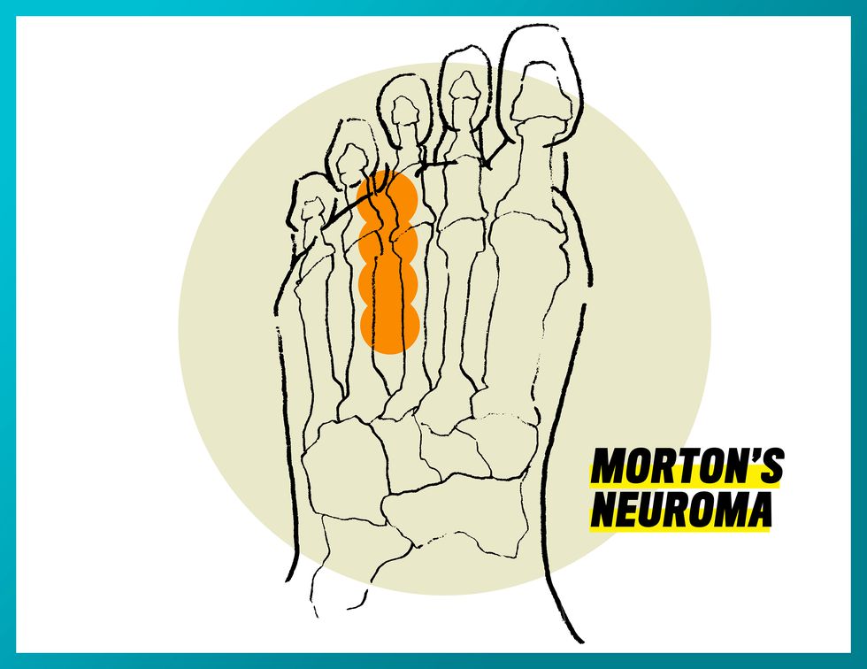 morton's neuroma