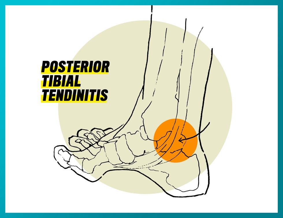 posterior tibial tendinitis