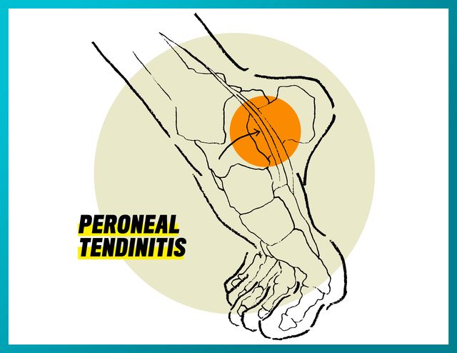 peroneal tendinitis
