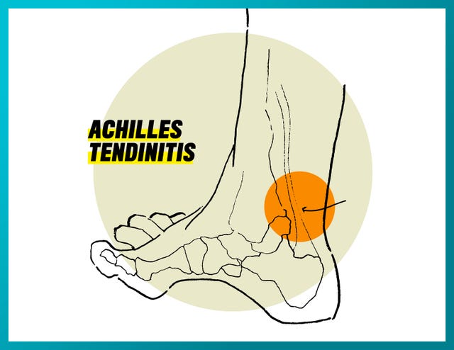 achilles tendinitis