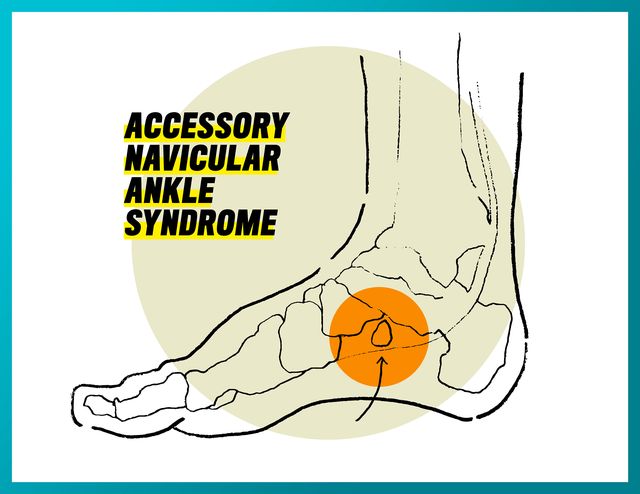 accessory navicular ankle syndrome