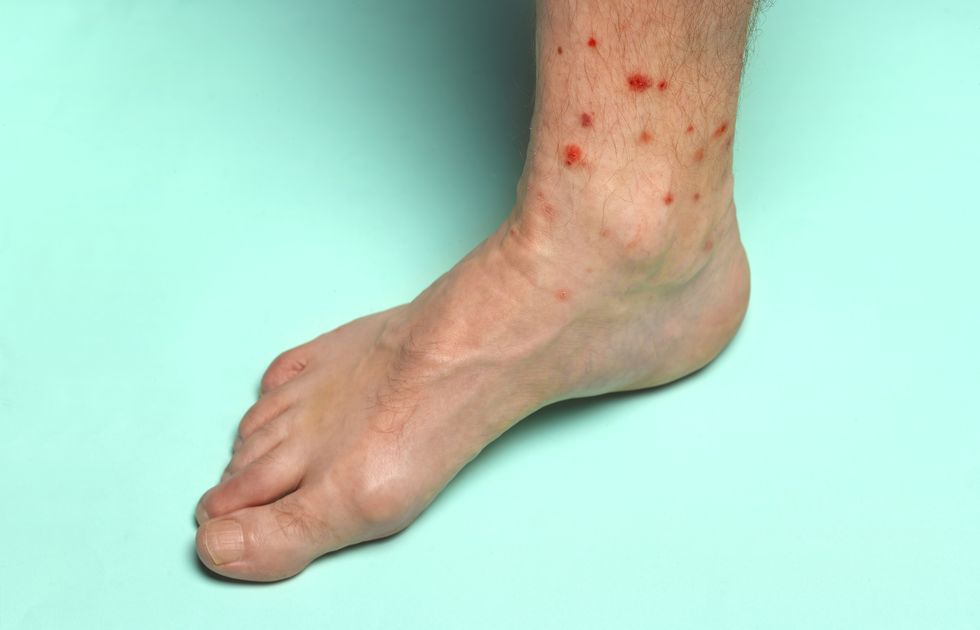 foot with summer insect bites