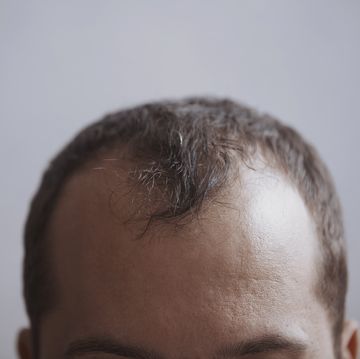 forehead of a man with receding hairline