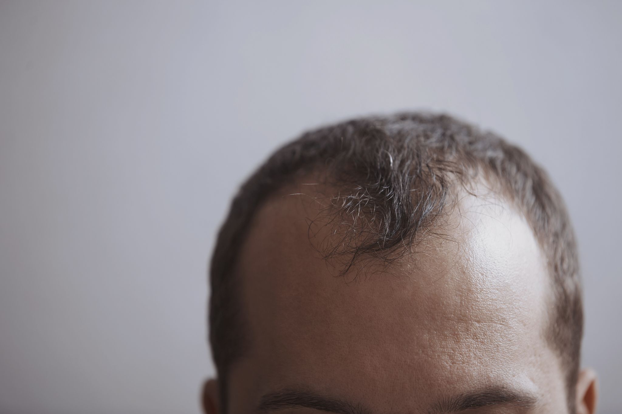 forehead of a man with receding hairline