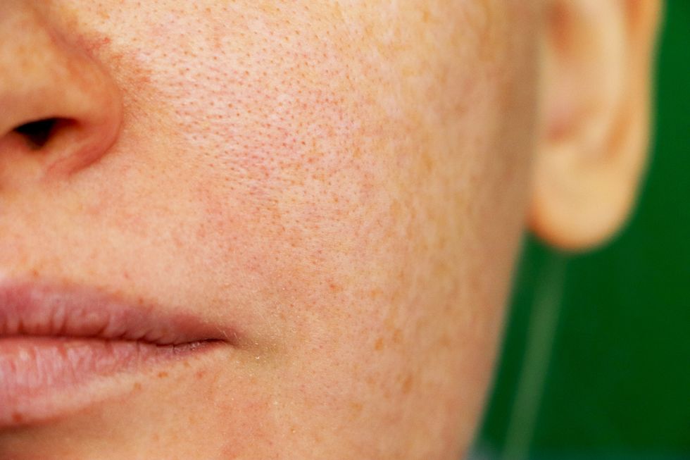 freckles, pigmentation, enlarged pores girl with problem skin