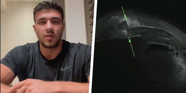 Boxer Tommy Fury Shares Hospital Scans To Prove Withdrawal From Jake ...