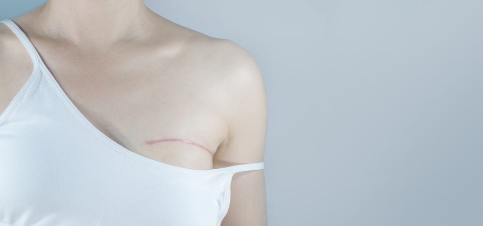 Breast cancer surgery scars