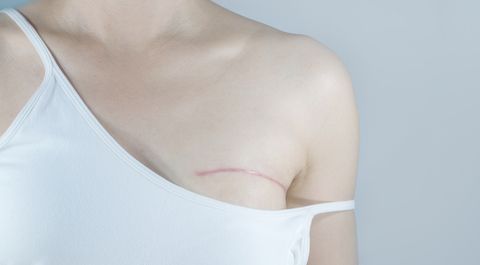 Breast cancer surgery scars
