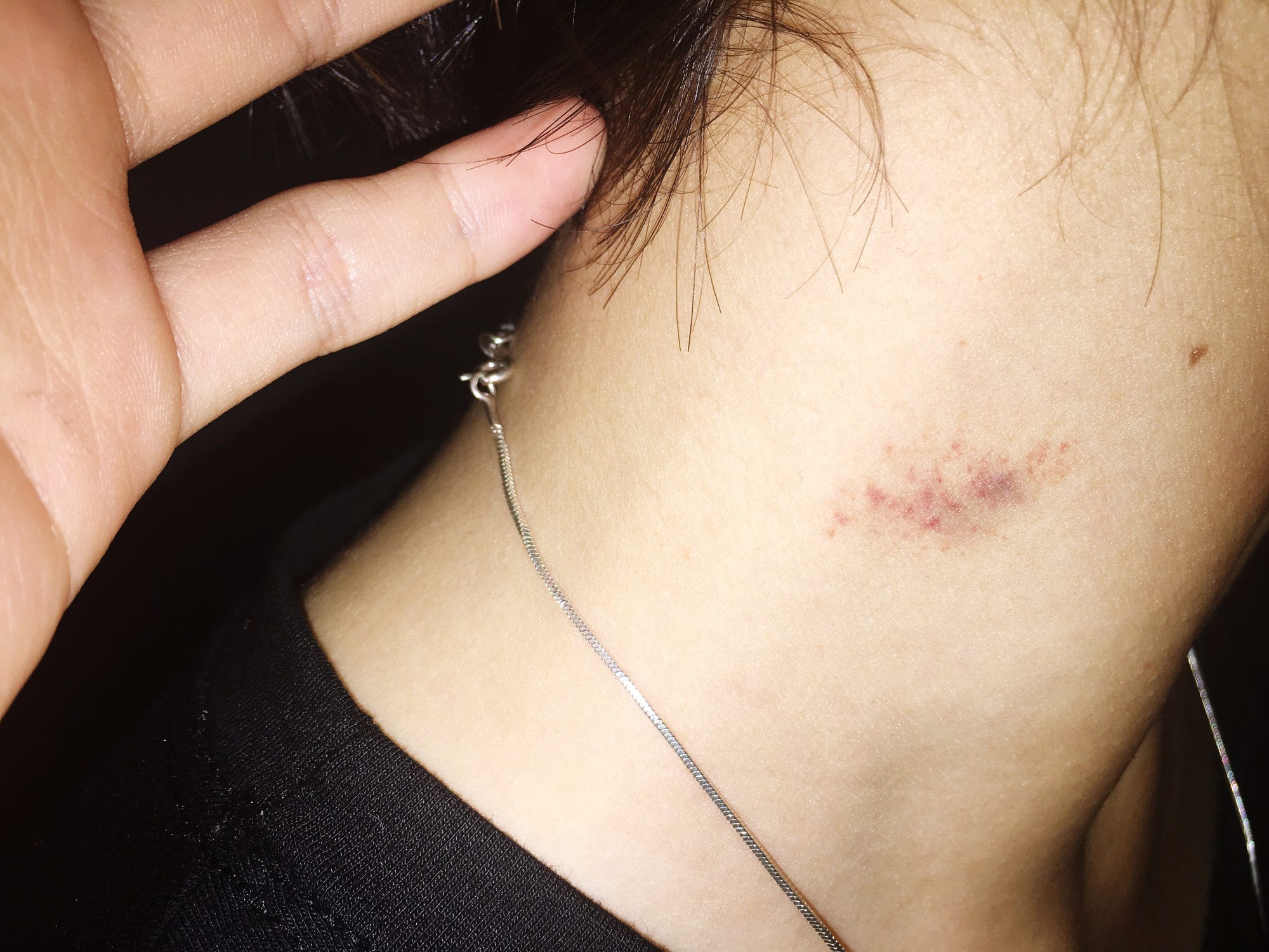 cum să scapi de un hickey