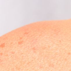 skin of a womans shoulder with birthmarks
