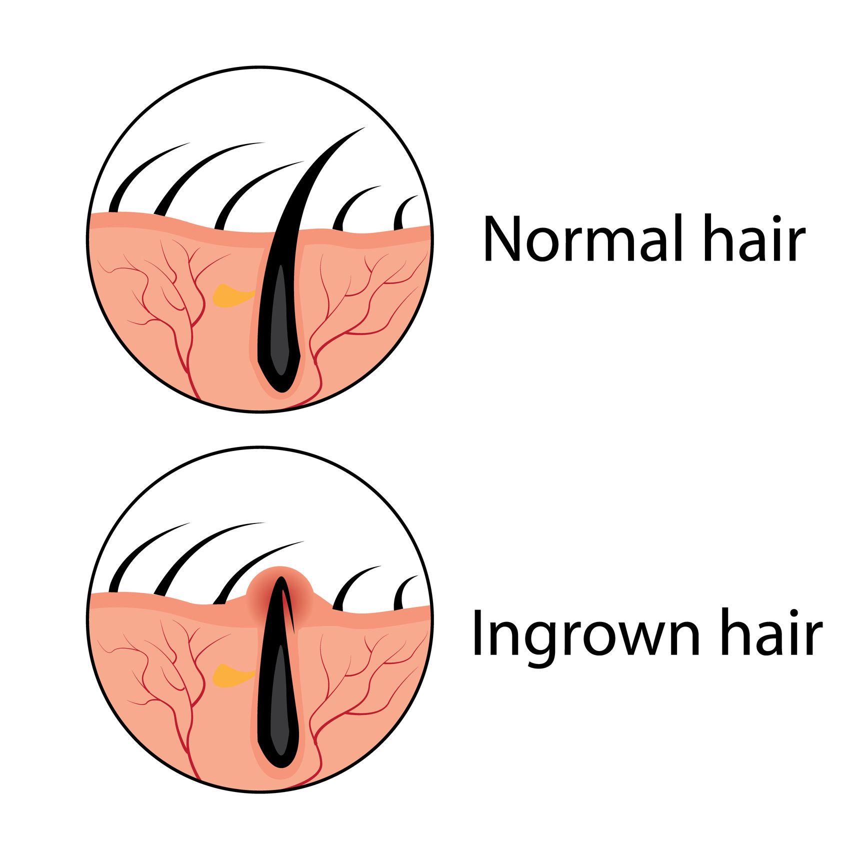 How to treat and care for ingrown hair at home  gelmersea