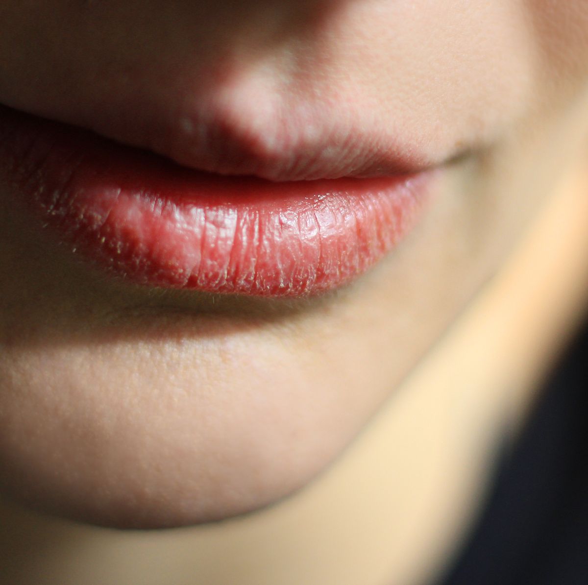 Chapped Lips Causes And Remedies, According To Dermatologists