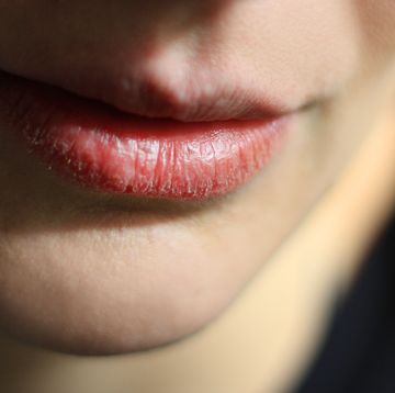 Close-Up Of Woman With Dry Lip At Home