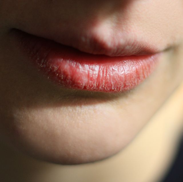 Close-Up Of Woman With Dry Lip At Home