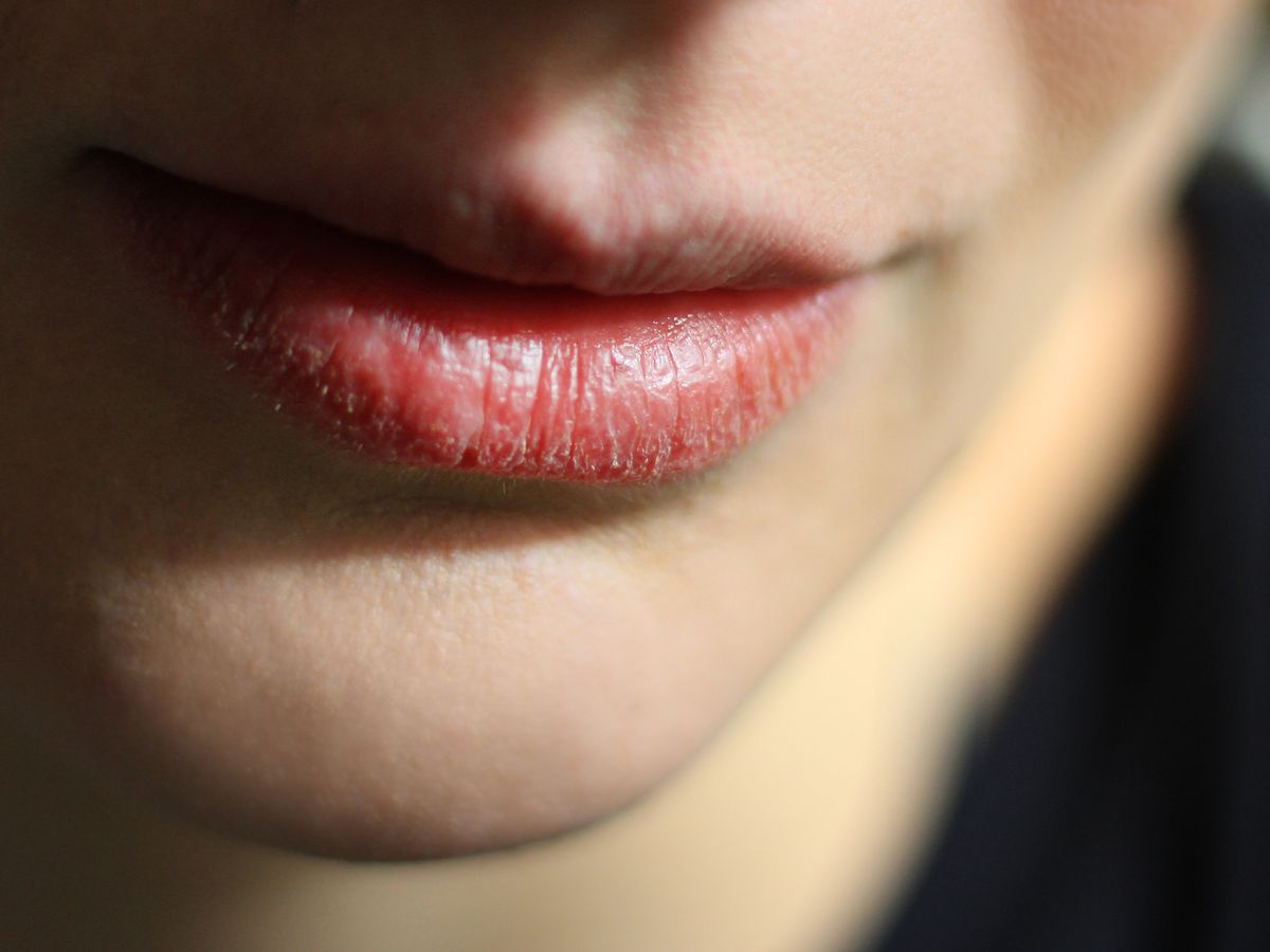 7 Natural Treatments For Sunburned Lips & Prevention Tips