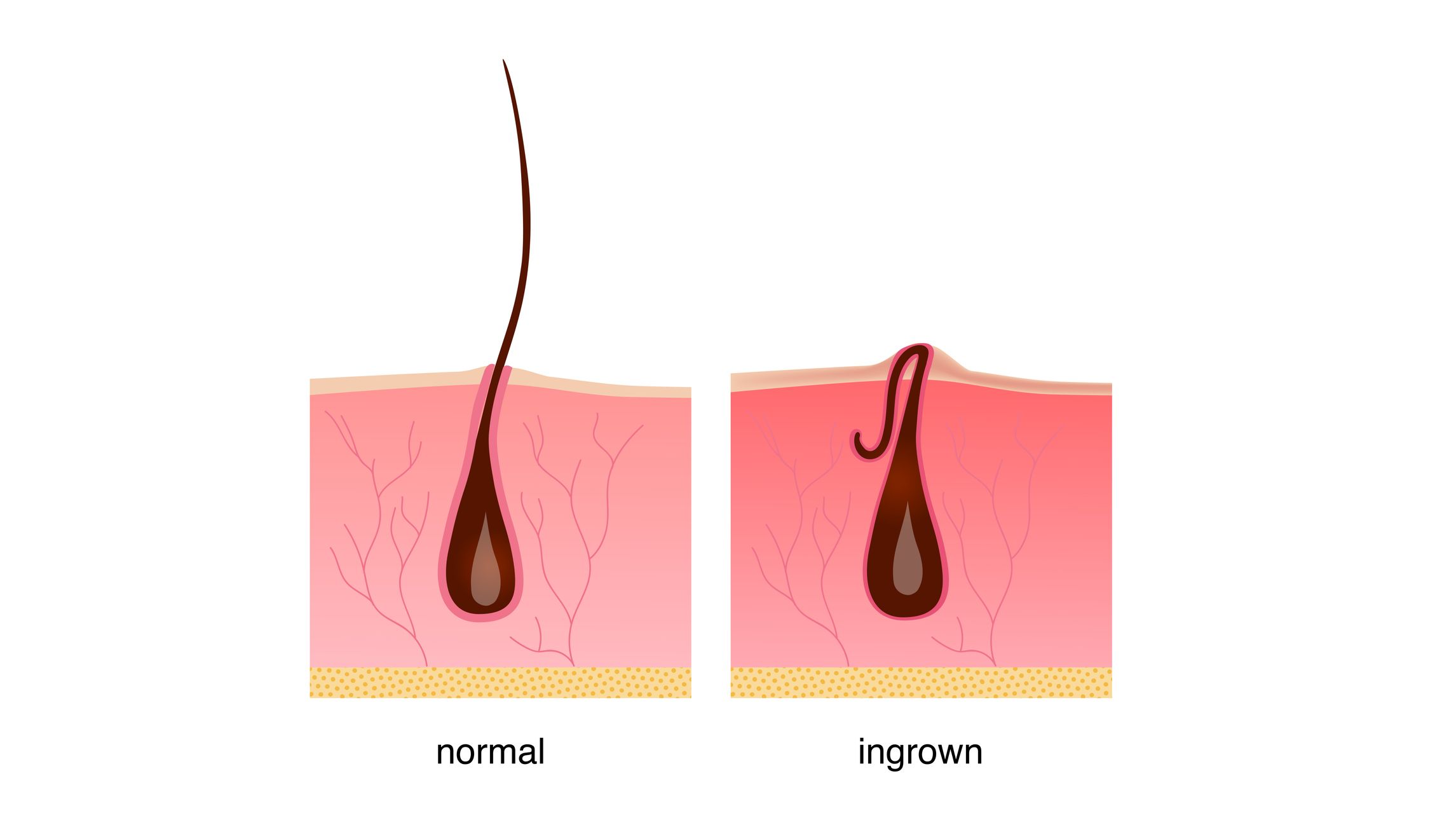 how-to-get-rid-of-ingrown-hair-on-face-woman-cheap-orders-save-47